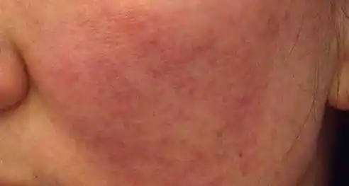 contoh skin barrier rusak
